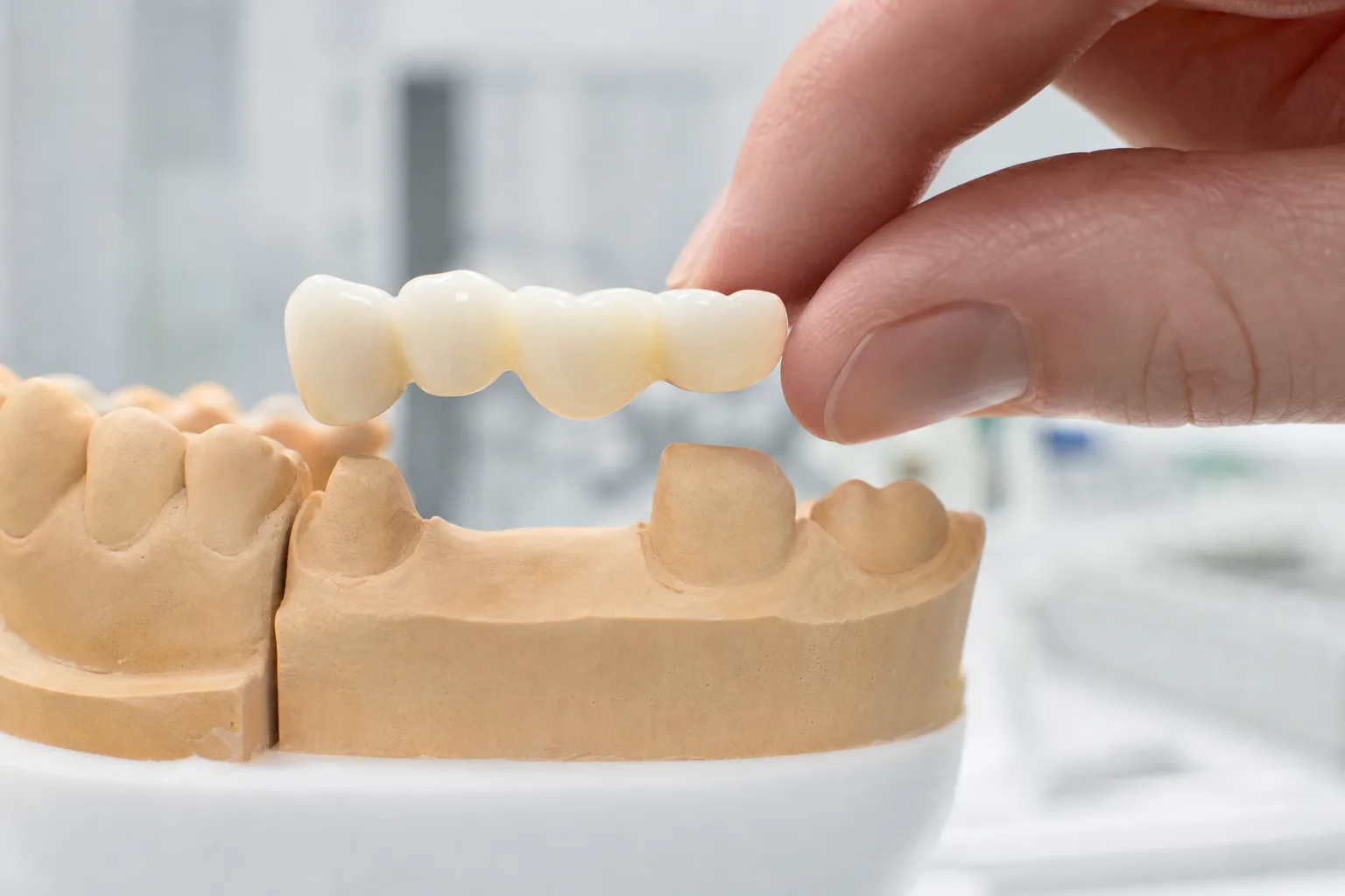 Dental Bridge intake preview
